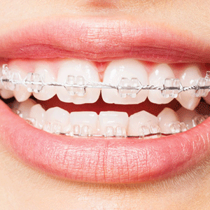 Ortodontija, breketai